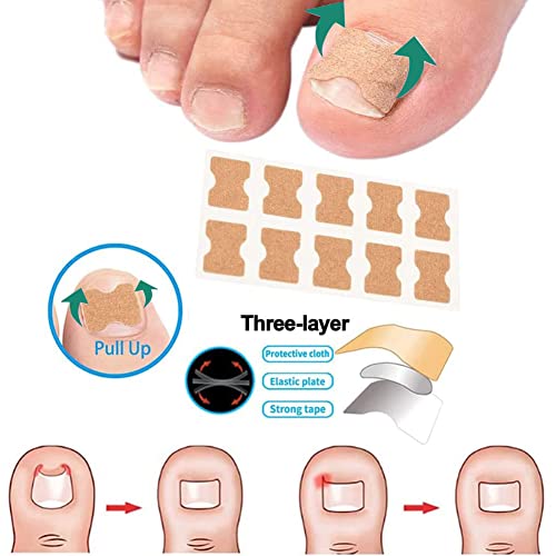 Patch-коректор за лак за нокти на краката, Лепенки за нокти, Стикери за корекция на врастнали нокти на краката, за Лечение на врастнали